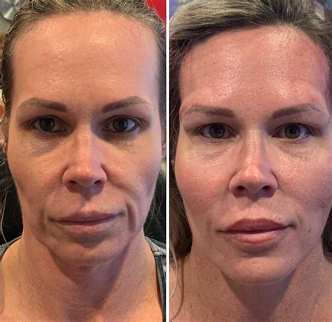 non surgical facelift new hartford  Learn which treatment is right for you